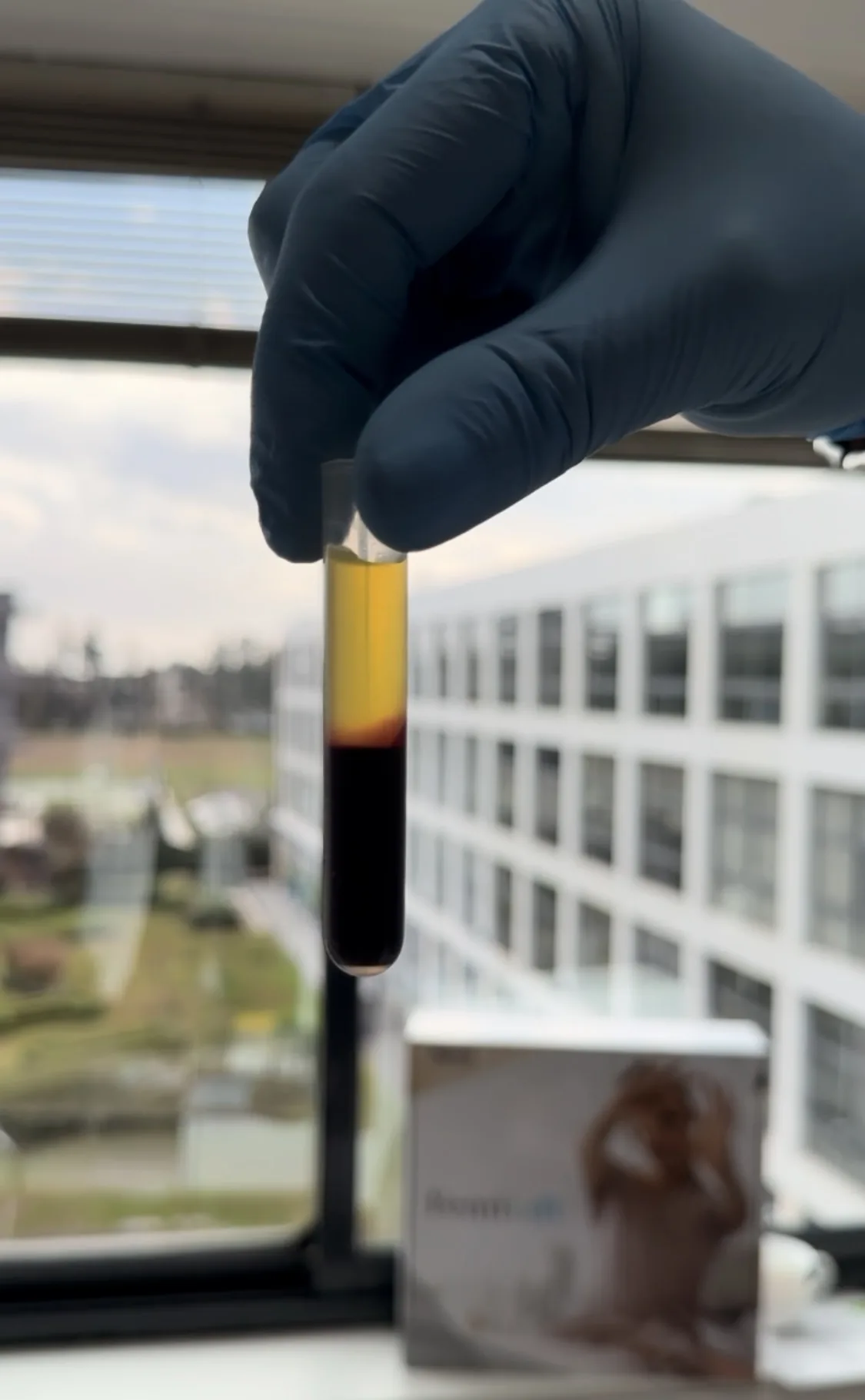 PRP capilar plasma rico en plaquetas tratamiento caída del cabello EMG