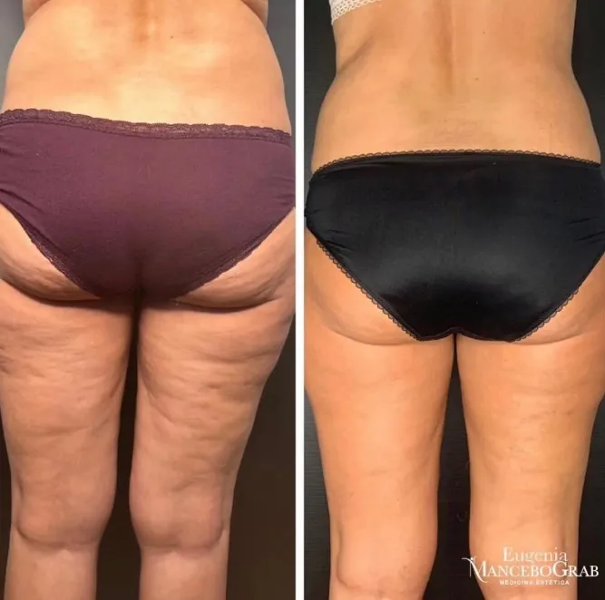Shaping Body modelado corporal EMG
